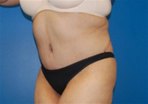 Tummy Tuck Before and After | SGK Plastic Surgery