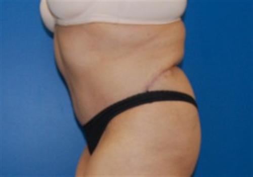 Tummy Tuck Before and After | SGK Plastic Surgery