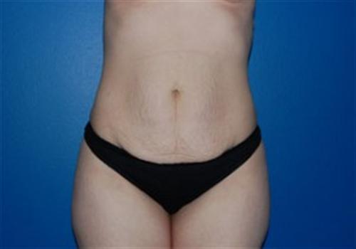 Tummy Tuck Before and After | SGK Plastic Surgery