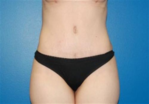 Tummy Tuck Before and After | SGK Plastic Surgery