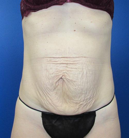 Tummy Tuck Before and After | SGK Plastic Surgery