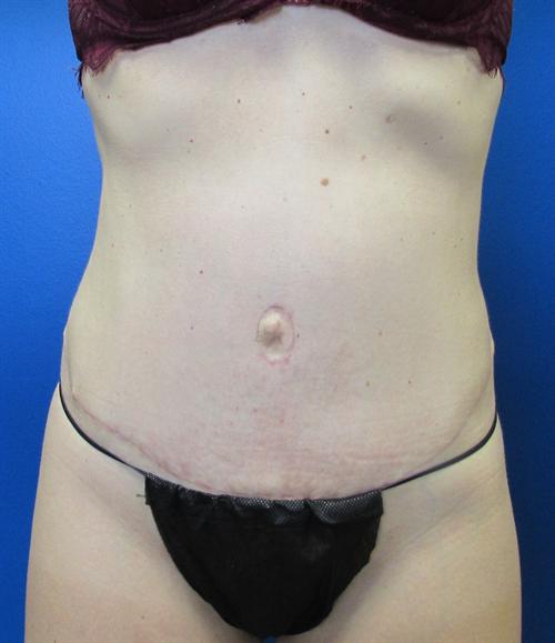 Tummy Tuck Before and After | SGK Plastic Surgery