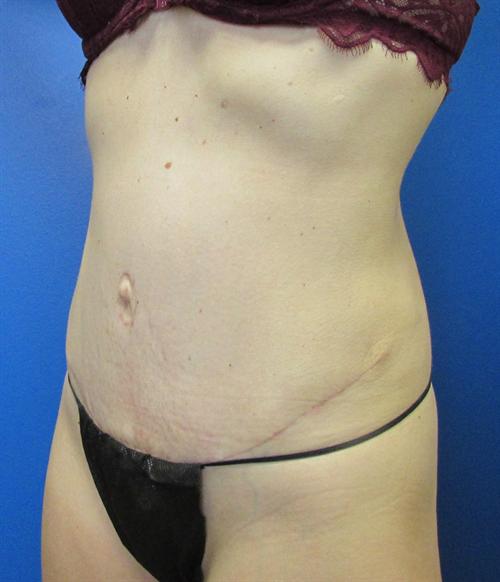 Tummy Tuck Before and After | SGK Plastic Surgery