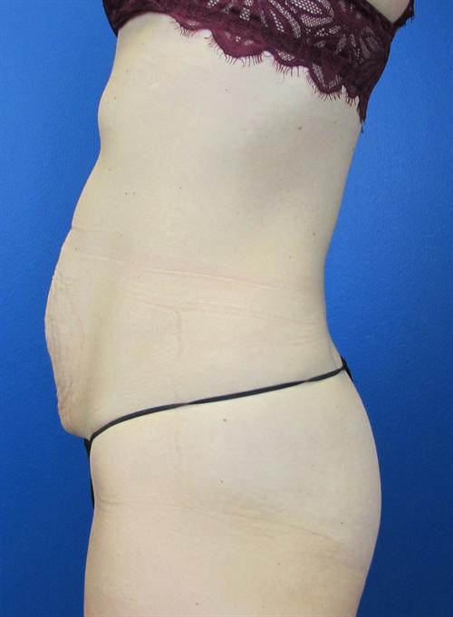 Tummy Tuck Before and After | SGK Plastic Surgery