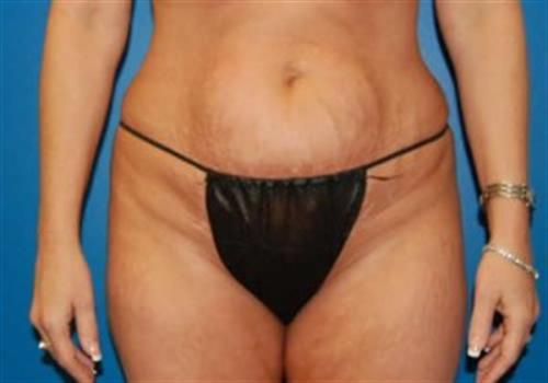 Tummy Tuck Before and After | SGK Plastic Surgery