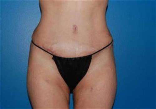 Tummy Tuck Before and After | SGK Plastic Surgery