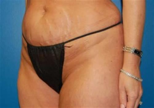 Tummy Tuck Before and After | SGK Plastic Surgery