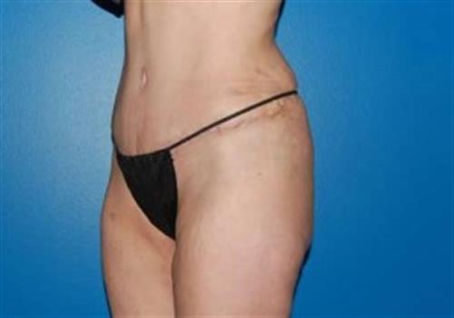 Tummy Tuck Before and After | SGK Plastic Surgery