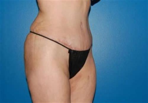 Tummy Tuck Before and After | SGK Plastic Surgery