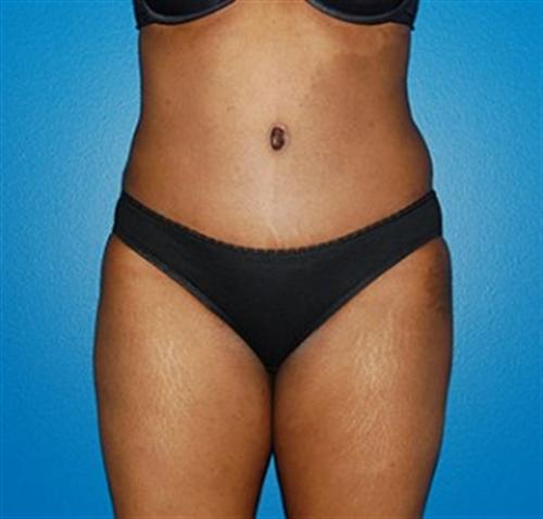 Tummy Tuck Before and After 80