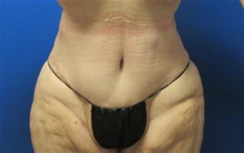 Tummy Tuck Before and After | SGK Plastic Surgery