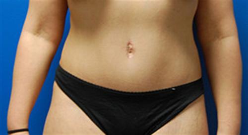 Tummy Tuck Before and After | SGK Plastic Surgery