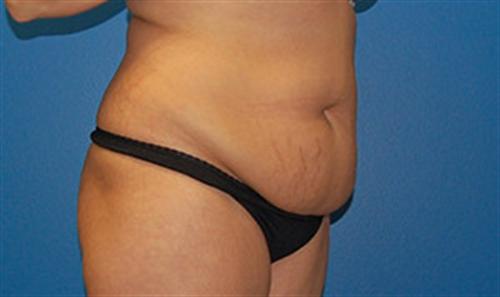 Tummy Tuck Before and After | SGK Plastic Surgery