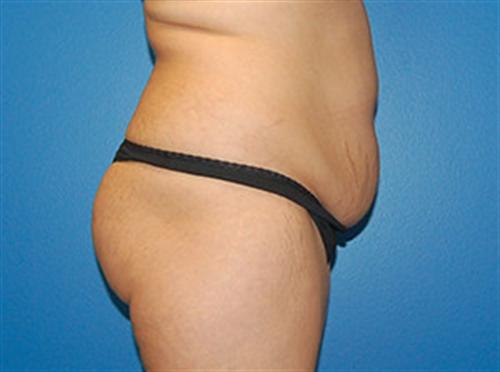 Tummy Tuck Before and After | SGK Plastic Surgery