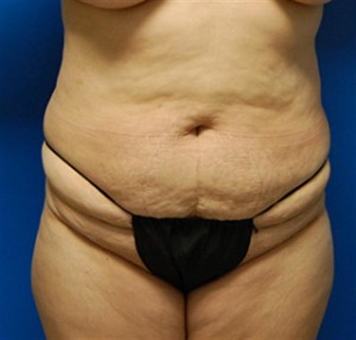 Tummy Tuck Before and After | SGK Plastic Surgery