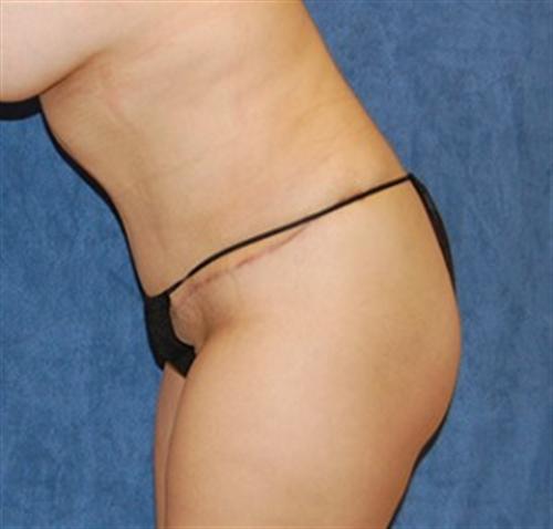 Tummy Tuck Before and After | SGK Plastic Surgery