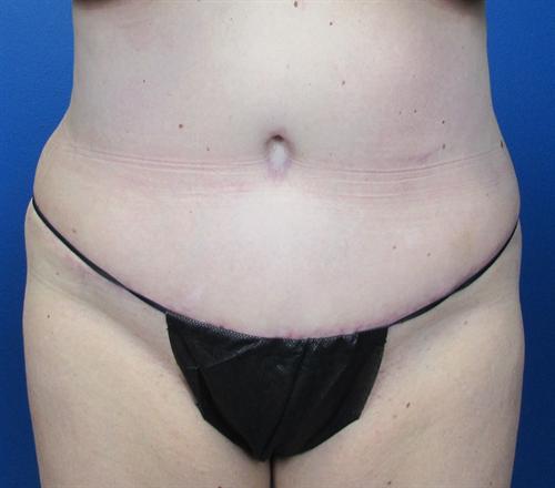 Tummy Tuck Before and After | SGK Plastic Surgery