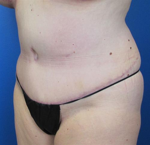 Tummy Tuck Before and After | SGK Plastic Surgery