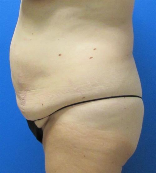 Tummy Tuck Before and After | SGK Plastic Surgery