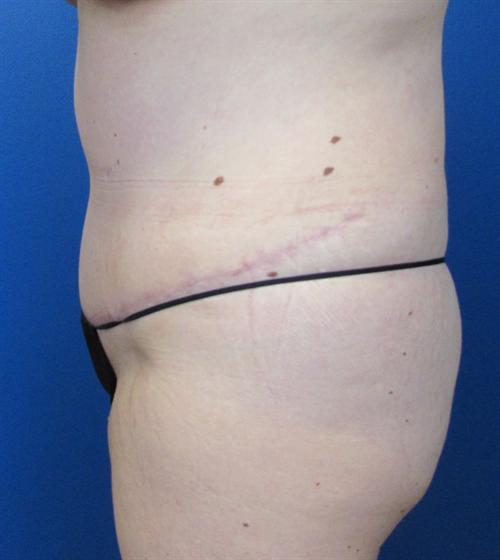 Tummy Tuck Before and After | SGK Plastic Surgery