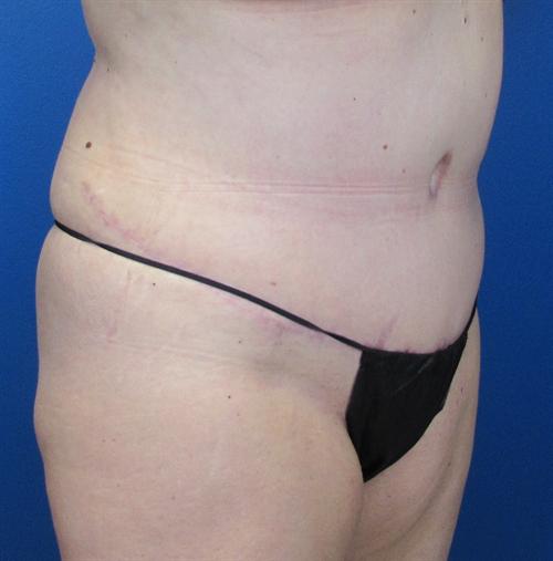 Tummy Tuck Before and After | SGK Plastic Surgery