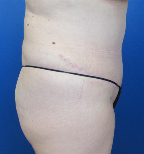 Tummy Tuck Before and After | SGK Plastic Surgery