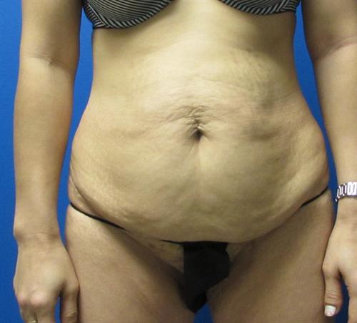 Tummy Tuck Before and After | SGK Plastic Surgery