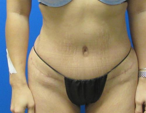 Tummy Tuck Before and After | SGK Plastic Surgery