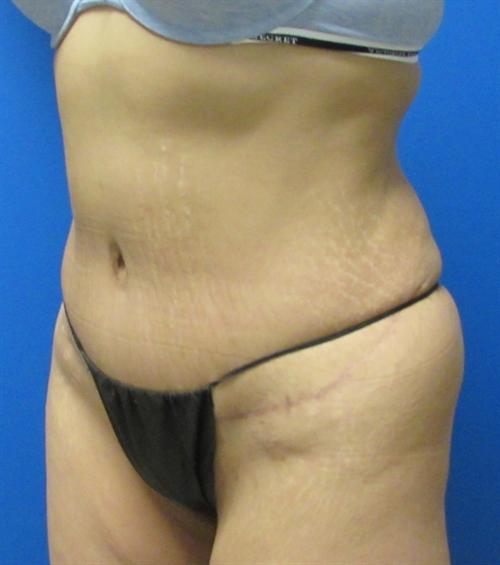 Tummy Tuck Before and After | SGK Plastic Surgery