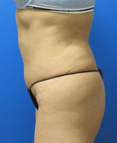 Tummy Tuck Before and After | SGK Plastic Surgery