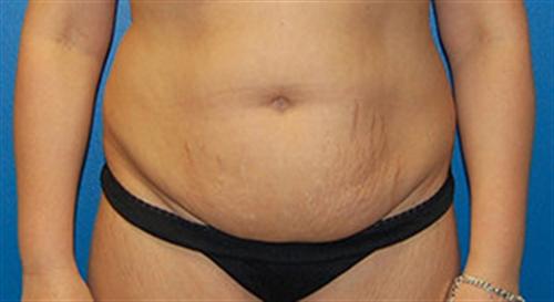 Tummy Tuck Before and After | SGK Plastic Surgery