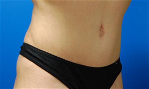 Tummy Tuck Before and After | SGK Plastic Surgery