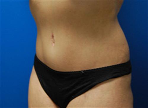 Tummy Tuck Before and After | SGK Plastic Surgery