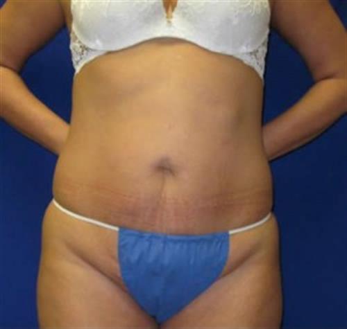 Tummy Tuck Before and After | SGK Plastic Surgery