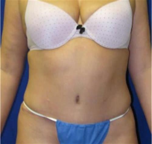 Tummy Tuck Before and After | SGK Plastic Surgery