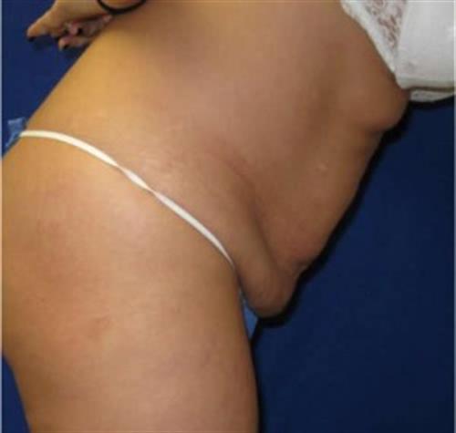 Tummy Tuck Before and After | SGK Plastic Surgery