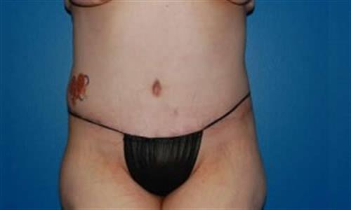 Tummy Tuck Before and After | SGK Plastic Surgery