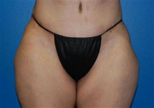 Tummy Tuck Before and After | SGK Plastic Surgery