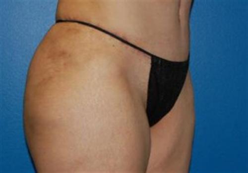 Tummy Tuck Before and After | SGK Plastic Surgery