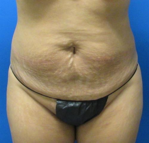 Tummy Tuck Before and After | SGK Plastic Surgery