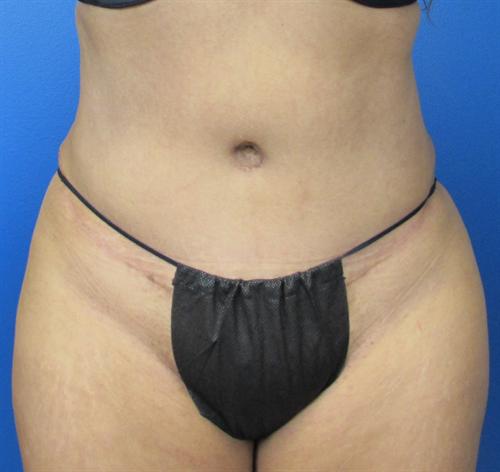 Tummy Tuck Before and After | SGK Plastic Surgery