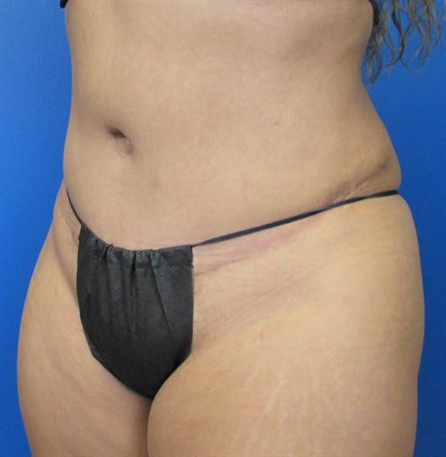 Tummy Tuck Before and After | SGK Plastic Surgery