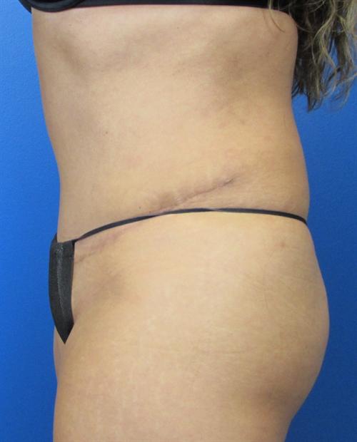 Tummy Tuck Before and After | SGK Plastic Surgery