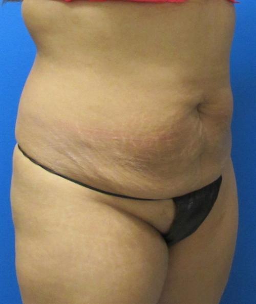 Tummy Tuck Before and After | SGK Plastic Surgery