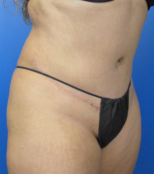 Tummy Tuck Before and After | SGK Plastic Surgery