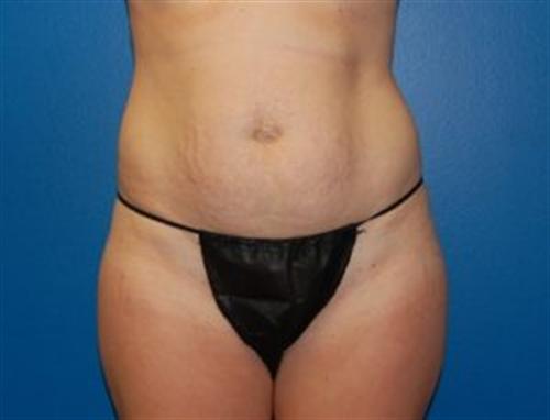 Tummy Tuck Before and After | SGK Plastic Surgery