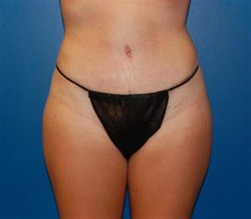 Tummy Tuck Before and After | SGK Plastic Surgery