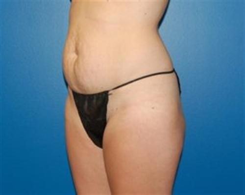 Tummy Tuck Before and After | SGK Plastic Surgery