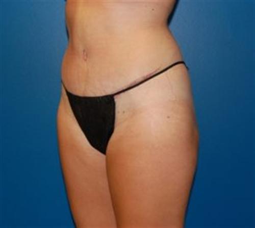 Tummy Tuck Before and After | SGK Plastic Surgery