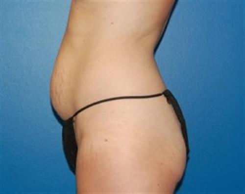 Tummy Tuck Before and After | SGK Plastic Surgery